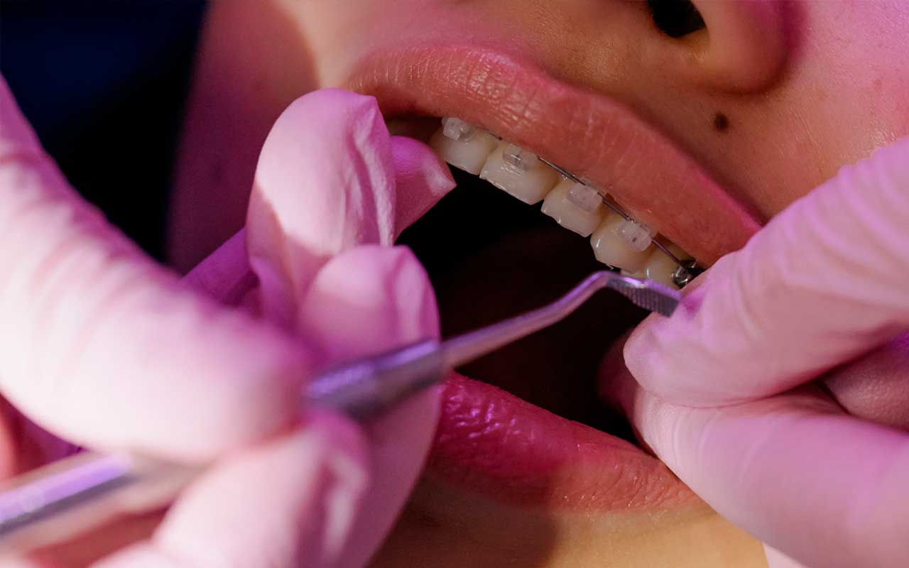 Un estudio japonés concluye que múltiples tipos de bacterias pueden contribuir a la pérdida ósea periodontal